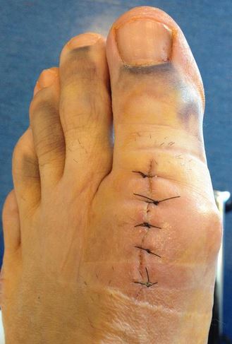 Toe right after surgery